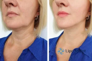 Double chin before and after Hi-Fu treatment 4 Book your double chin treatment Northwood today! We are here to help!