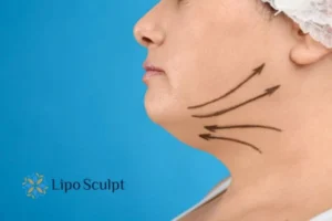 Double chin before and after Hi-Fu treatment 3 Boost your confidence with a Double chin treatment Northwood