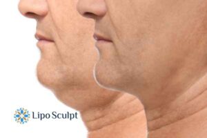 Double chin before and after Hi-Fu treatment 2 Double chin treatment Northwood from Lipo Sculpt - feel more confident today!