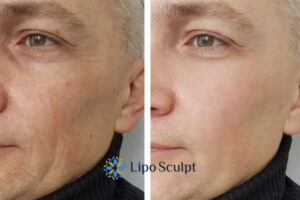 How to Fight Aging Symptoms 3 Fight Aging Symptoms Northwood With HIFU and Morpheus8 Today!