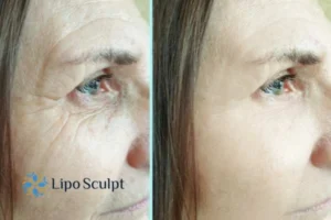 How to Fight Aging Symptoms 2 Do you want to Fight Aging Symptoms Northwood? Contact Lipo Sculpt today!