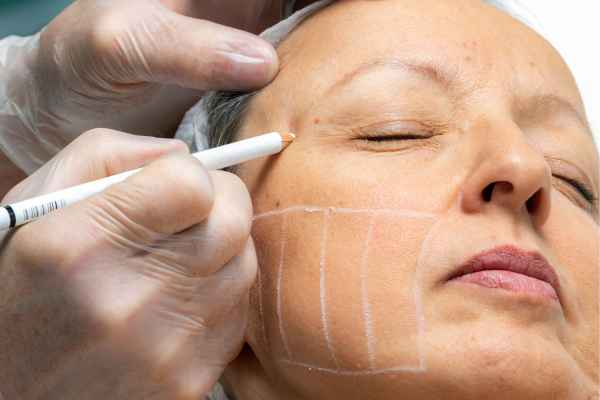 CryoPen: 5 Skin Concerns It May Be Used to Treat 4 What should you ask before having CryoPen treatment Northwood?
