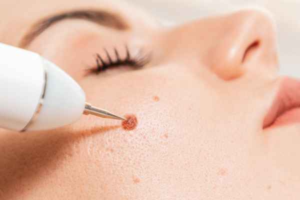 CryoPen: 5 Skin Concerns It May Be Used to Treat 3 What actually happens during a CryoPen treatment Northwood?