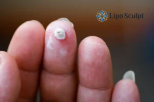 Cryopen Top 5 Treatable Conditions 4 Do you have a persistent wart of verruca that you cannot shit? Cryopen Northwood treatment will work call us NOW!