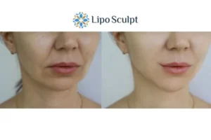 Explaining Total Skin Tightening Treatment And What It Can Do For You 2 Do you want to boost your self confidence? Give Morpheus8 Northwood a try today!
