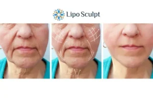 Explaining Total Skin Tightening Treatment And What It Can Do For You 3 Boost your confidence with Morpheus8 Northwood call our team today!