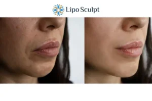 Explaining Total Skin Tightening Treatment And What It Can Do For You 4 Morpheus8 Northwood the best results - call our team today!