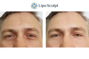 Explaining Total Skin Tightening Treatment And What It Can Do For You 6 Morpheus8 Northwood book in today to find out more!