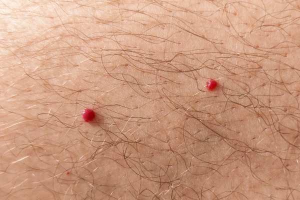CryoPen: 5 Skin Concerns It May Be Used to Treat 2 cherry angioma removal Northwood