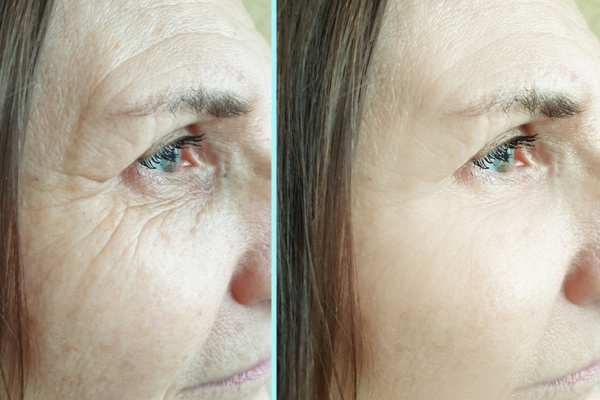 Why Do People Choose HIFU for a Non-Surgical Facelift? 4 How long can HIFU results last Northwood?
