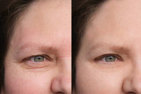 HIFU vs Botulinum Toxin: Understanding the Differences 4 How long do HIFU results last Northwood?