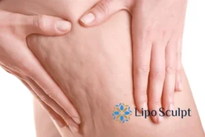 CoolSculpting for Legs: The Innovative Approach to Redefining Your Legs 5 Start your journey today book your coolsculpting treatment Northwood online today!