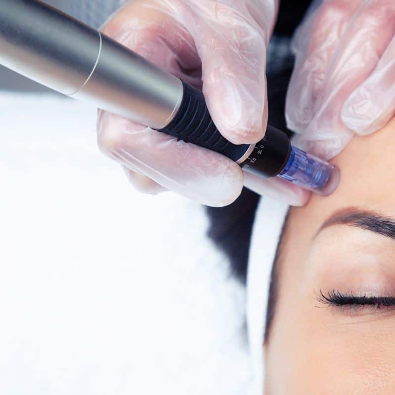 Morpheus8 treatment Northwood from Lipo Sculpt - Book in today!