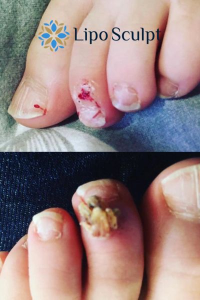Wart removal customer results from Lipo Sculpt Northwood
