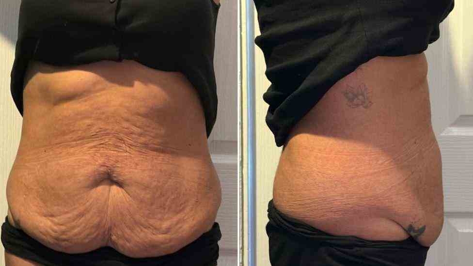 Lost the Weight but Not the Loose Skin? What You Should Know 1 Is It Definitely Loose Skin Northwood?
