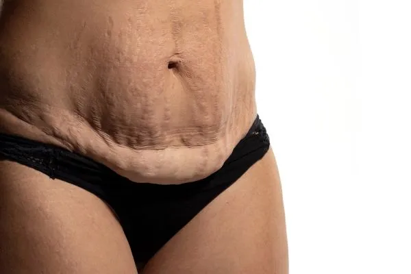 Lost the Weight but Not the Loose Skin? 1 image of womans stomach after weight loss showing loose skin Northwood